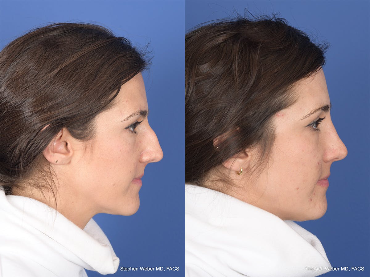 Rhinoplasty Before & After Gallery - Patient 283759 - Image 5