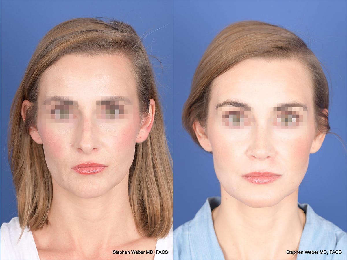 Rhinoplasty Before & After Gallery - Patient 313194 - Image 1