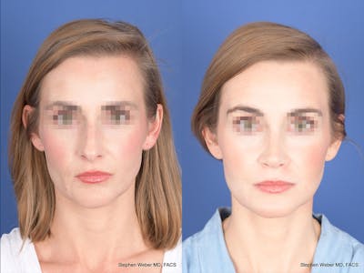Rhinoplasty Before & After Gallery - Patient 313194 - Image 1