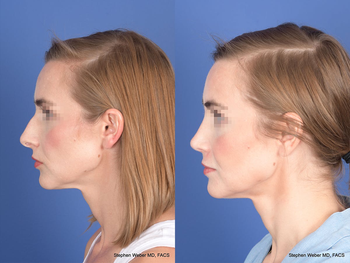 Rhinoplasty Before & After Gallery - Patient 313194 - Image 2