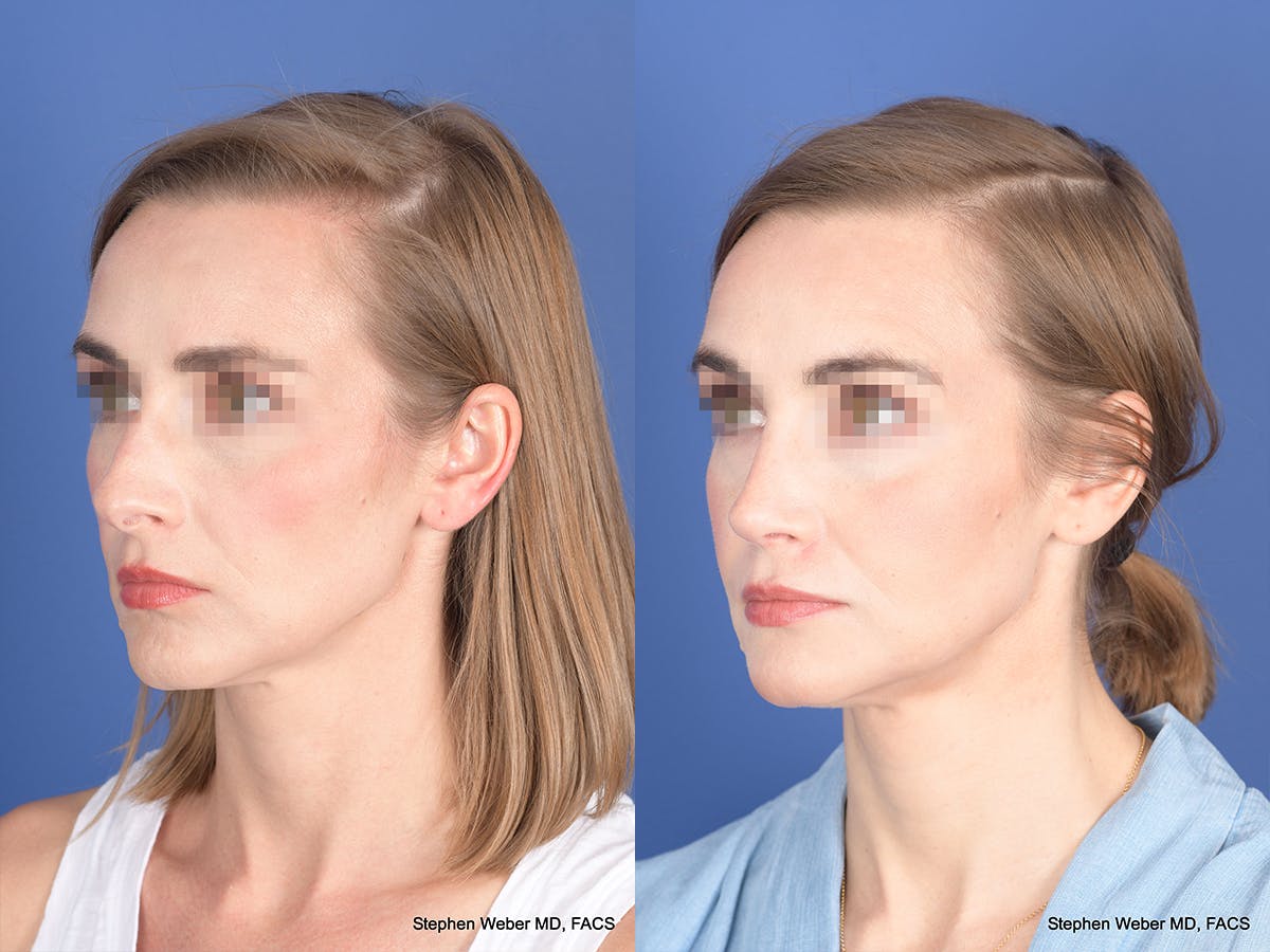 Rhinoplasty Before & After Gallery - Patient 313194 - Image 3