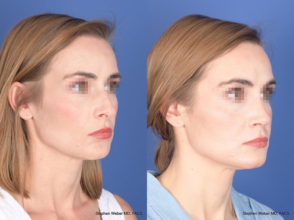Rhinoplasty Before & After Gallery - Patient 313194 - Image 4