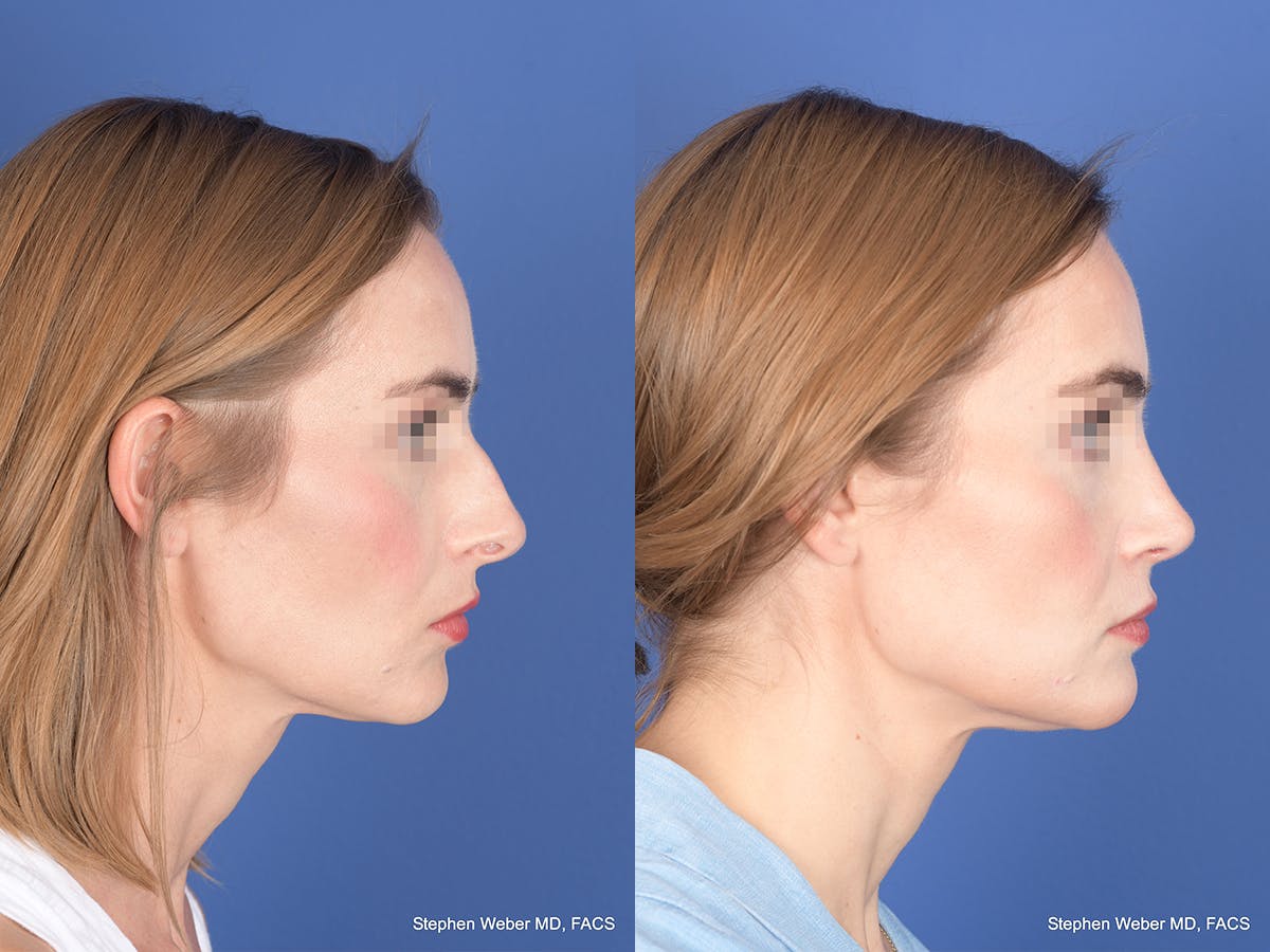 Rhinoplasty Before & After Gallery - Patient 313194 - Image 5