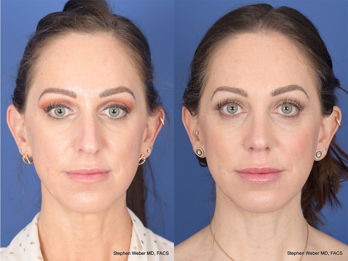 Rhinoplasty Before & After Gallery - Patient 373690 - Image 1