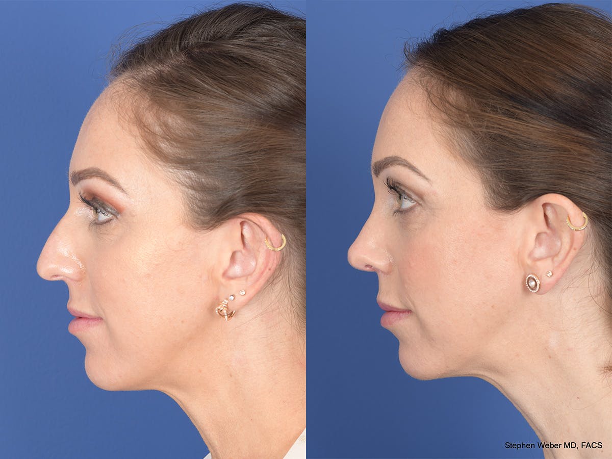 Rhinoplasty Before & After Gallery - Patient 373690 - Image 2