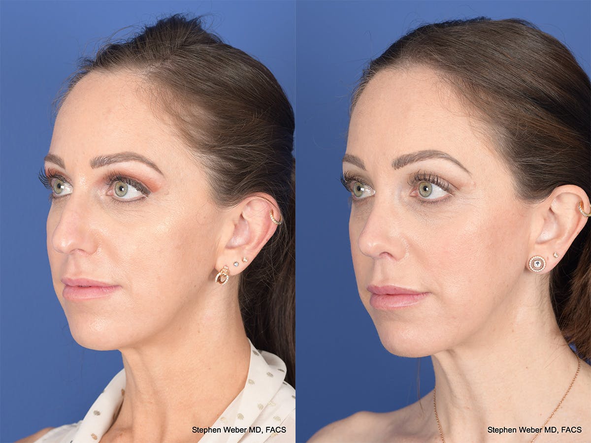 Rhinoplasty Before & After Gallery - Patient 373690 - Image 3