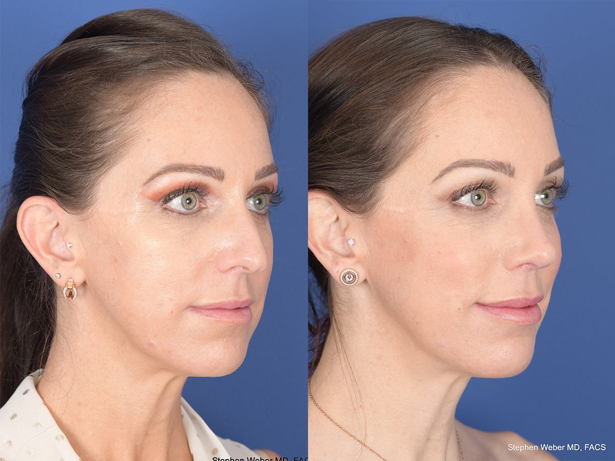Rhinoplasty Before & After Gallery - Patient 373690 - Image 4
