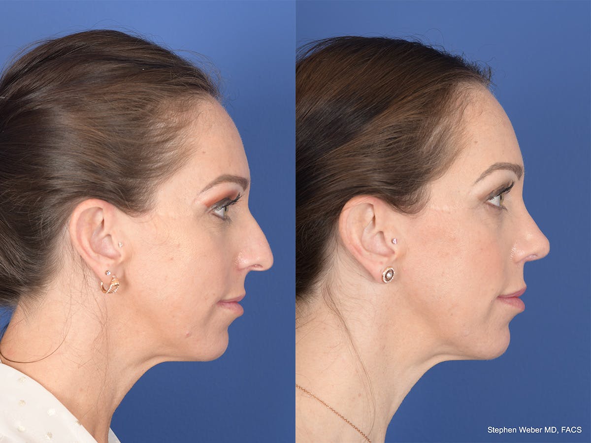 Rhinoplasty Before & After Gallery - Patient 373690 - Image 5