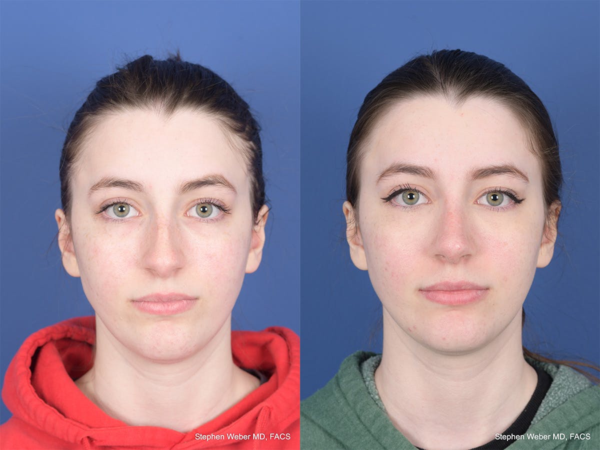Rhinoplasty Before & After Gallery - Patient 111116 - Image 1