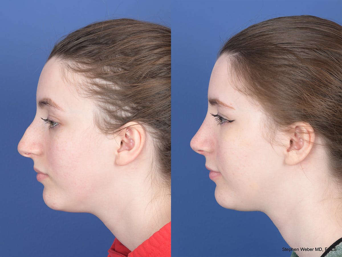 Rhinoplasty Before & After Gallery - Patient 111116 - Image 2