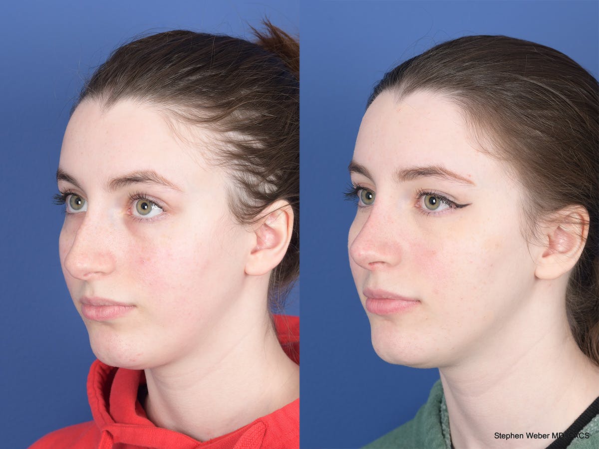 Rhinoplasty Before & After Gallery - Patient 111116 - Image 3