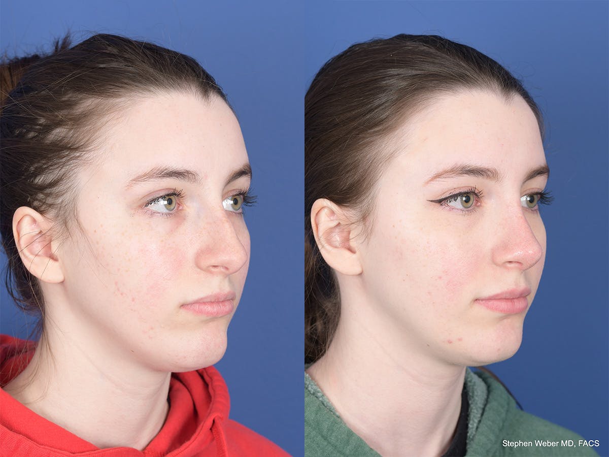Rhinoplasty Before & After Gallery - Patient 111116 - Image 4