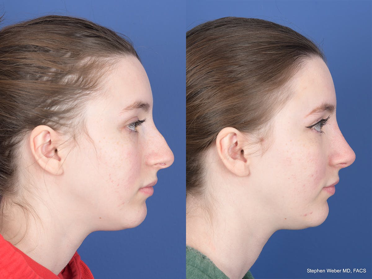 Rhinoplasty Before & After Gallery - Patient 111116 - Image 5