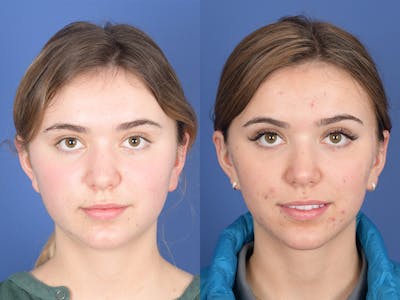 Rhinoplasty Before & After Gallery - Patient 206055 - Image 1