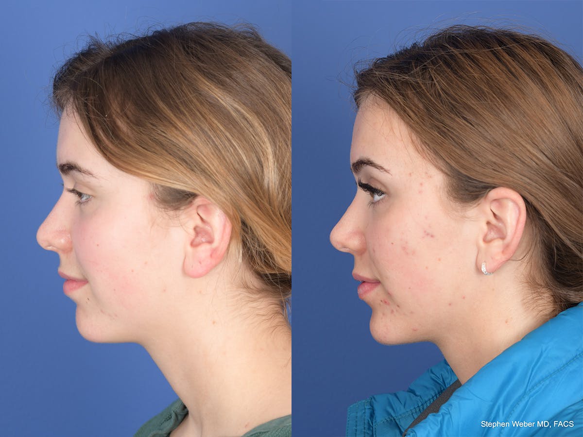 Rhinoplasty Before & After Gallery - Patient 206055 - Image 2