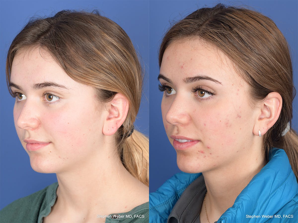 Rhinoplasty Before & After Gallery - Patient 206055 - Image 3