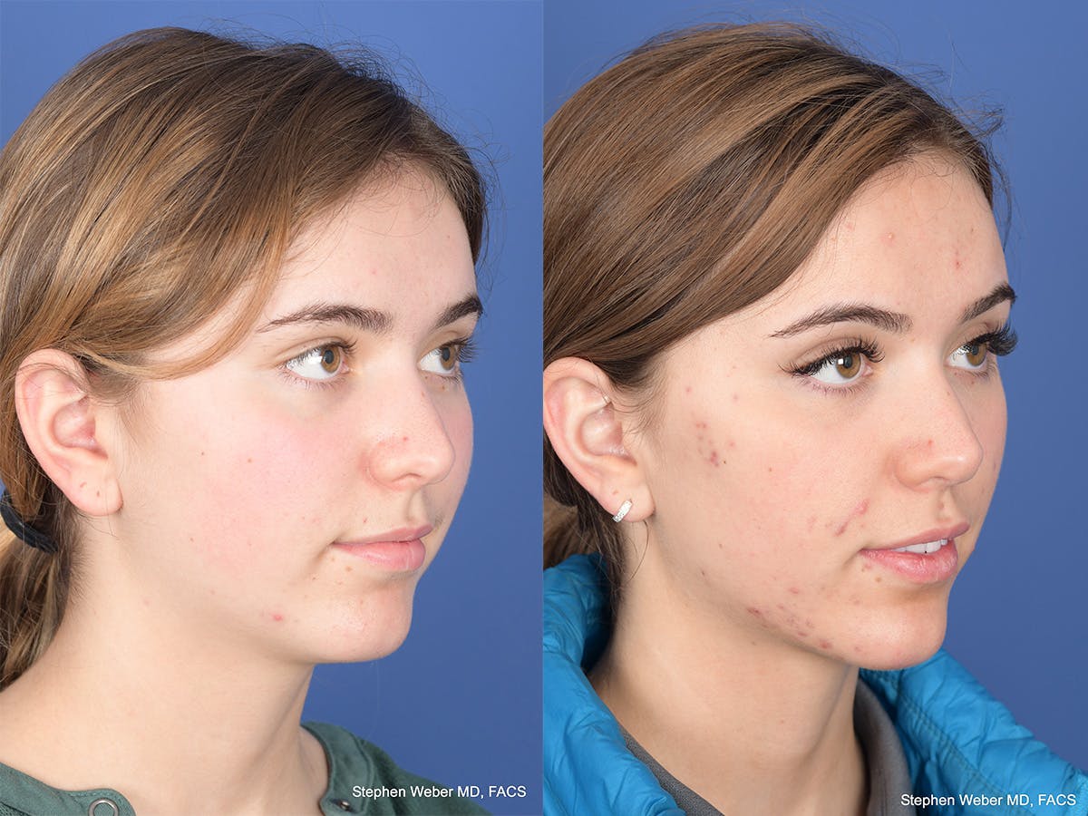 Rhinoplasty Before & After Gallery - Patient 206055 - Image 4