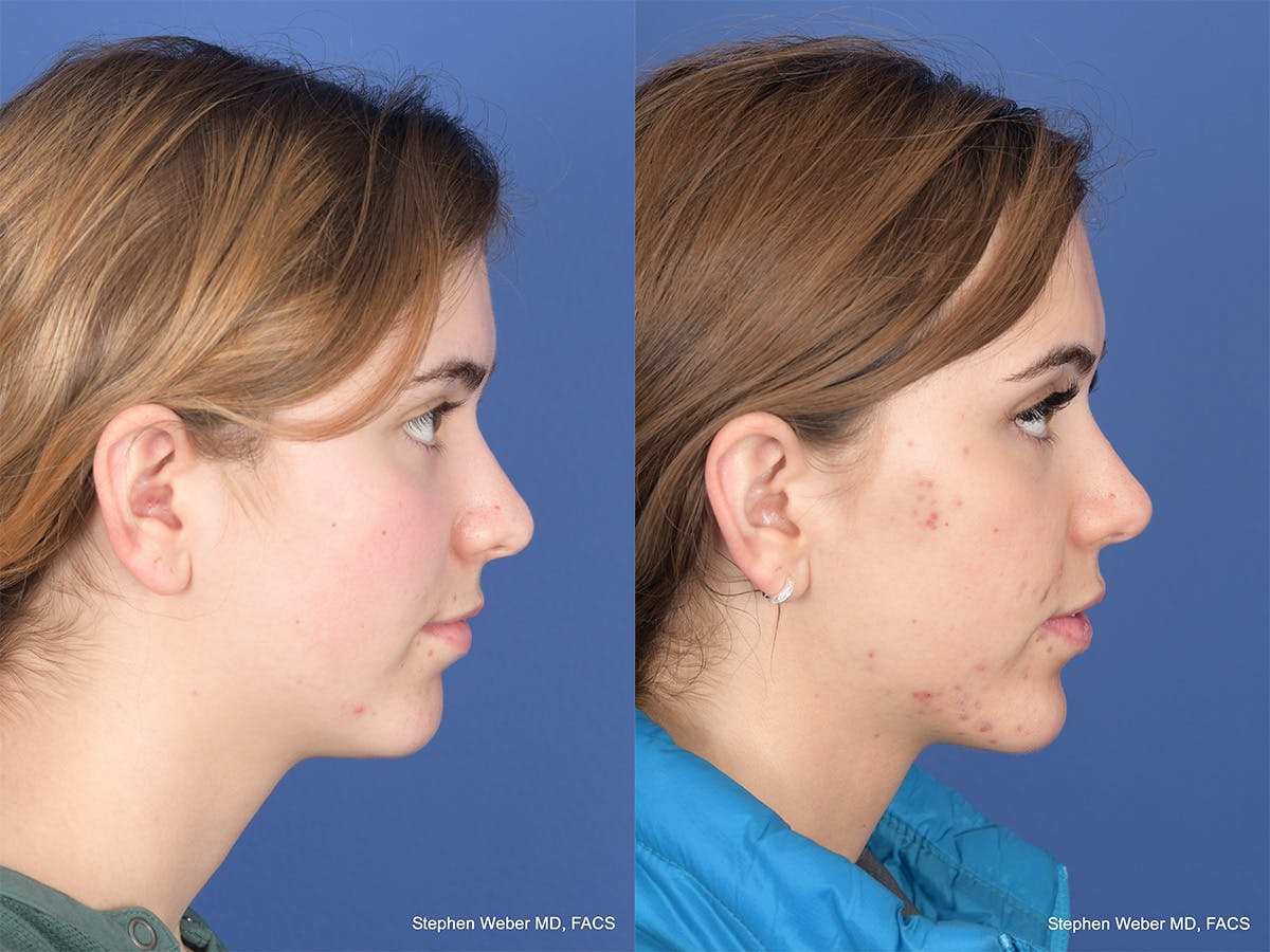 Rhinoplasty Before & After Gallery - Patient 206055 - Image 5