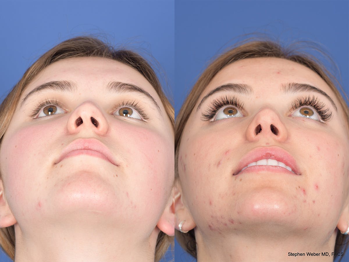 Rhinoplasty Before & After Gallery - Patient 206055 - Image 6