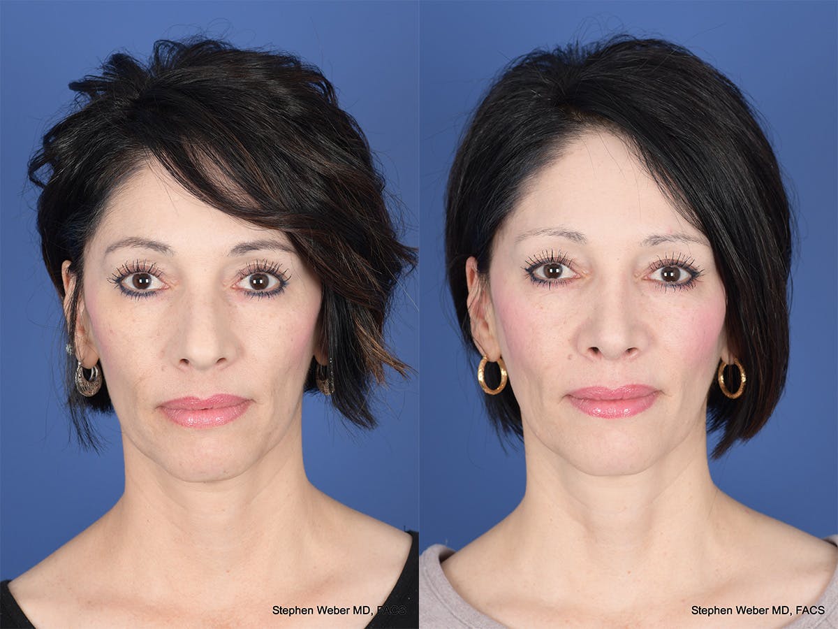 Rhinoplasty Before & After Gallery - Patient 353242 - Image 1