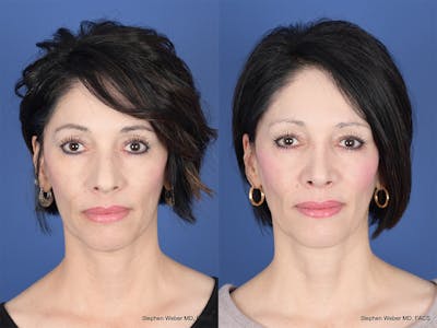 Rhinoplasty Before & After Gallery - Patient 353242 - Image 1