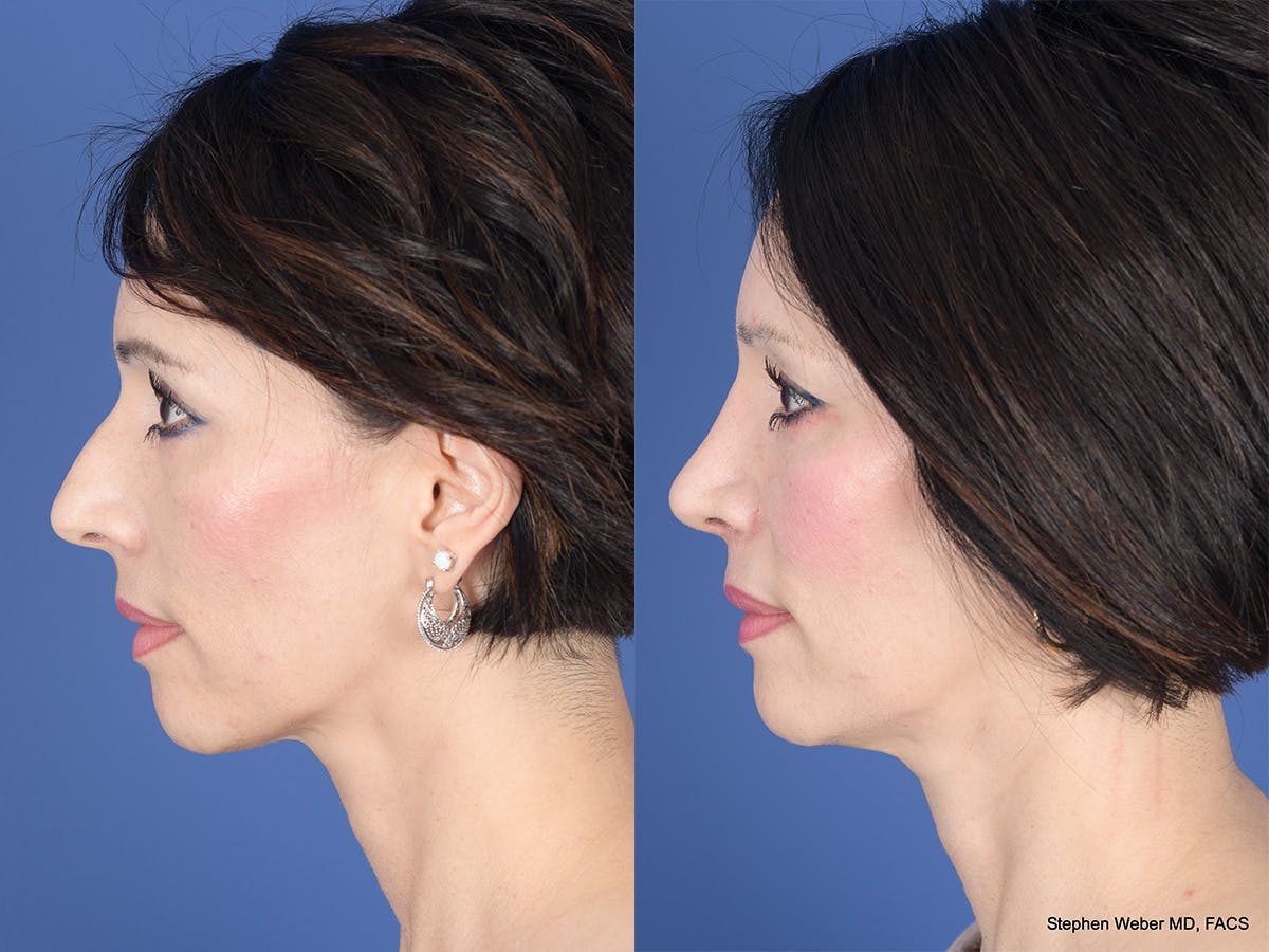 Rhinoplasty Before & After Gallery - Patient 353242 - Image 2