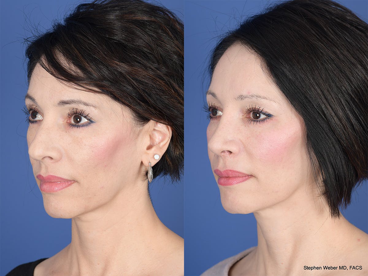 Rhinoplasty Before & After Gallery - Patient 353242 - Image 3