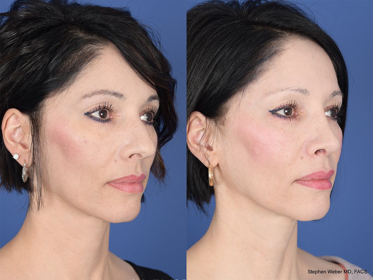 Rhinoplasty Before & After Gallery - Patient 353242 - Image 4