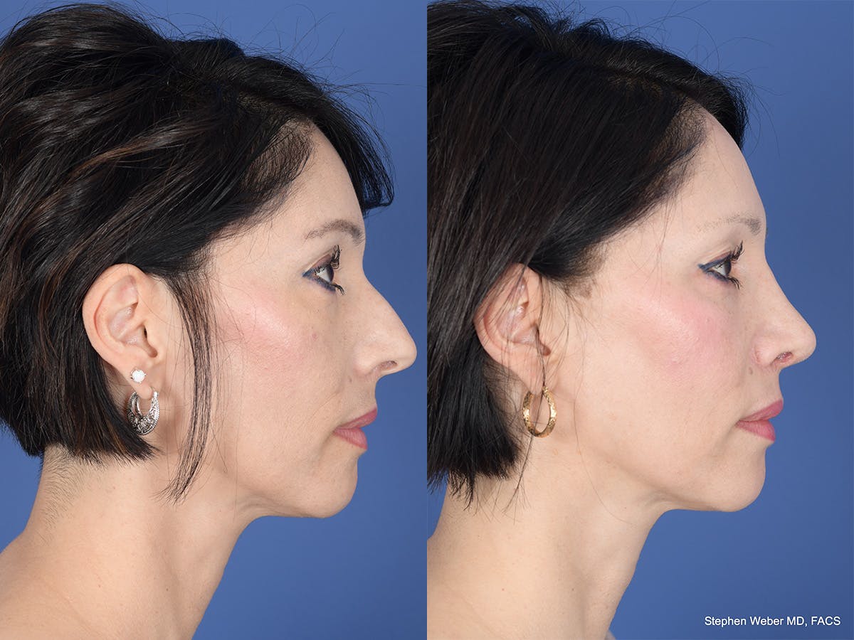 Rhinoplasty Before & After Gallery - Patient 353242 - Image 5