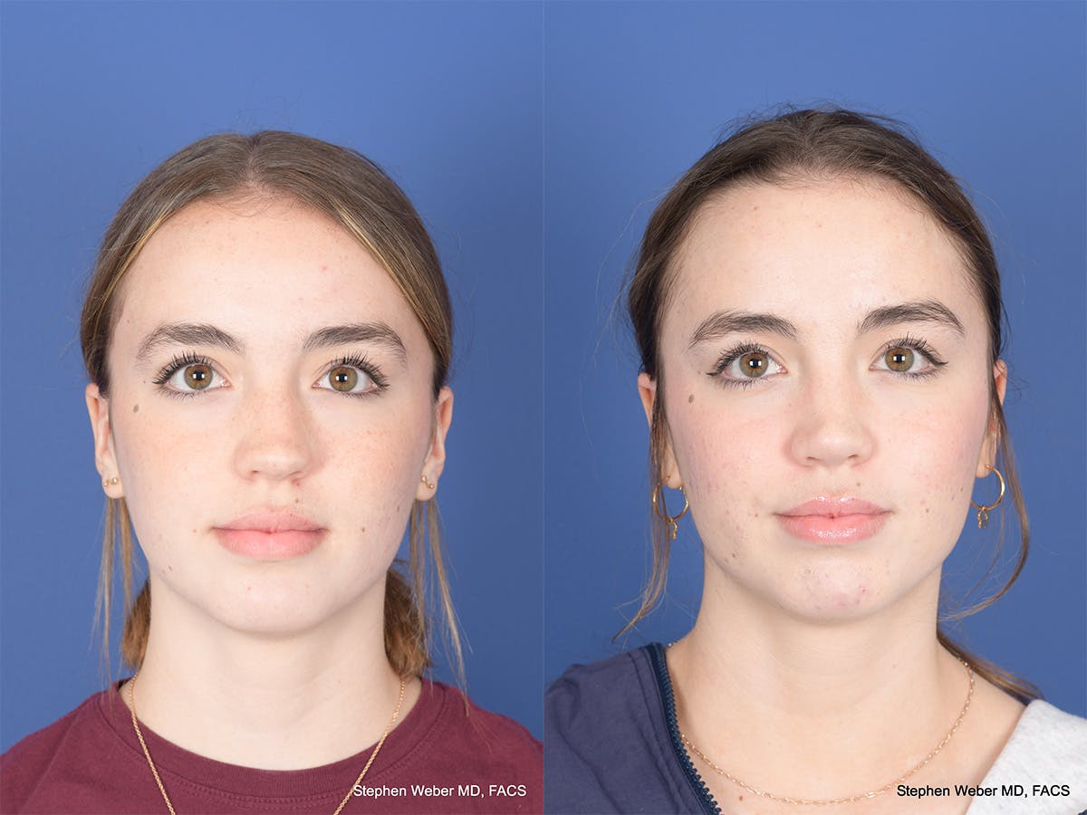 Rhinoplasty Before & After Gallery - Patient 190545 - Image 1
