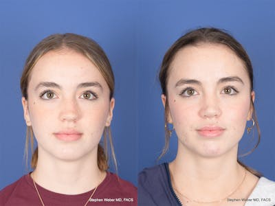 Rhinoplasty Before & After Gallery - Patient 190545 - Image 1