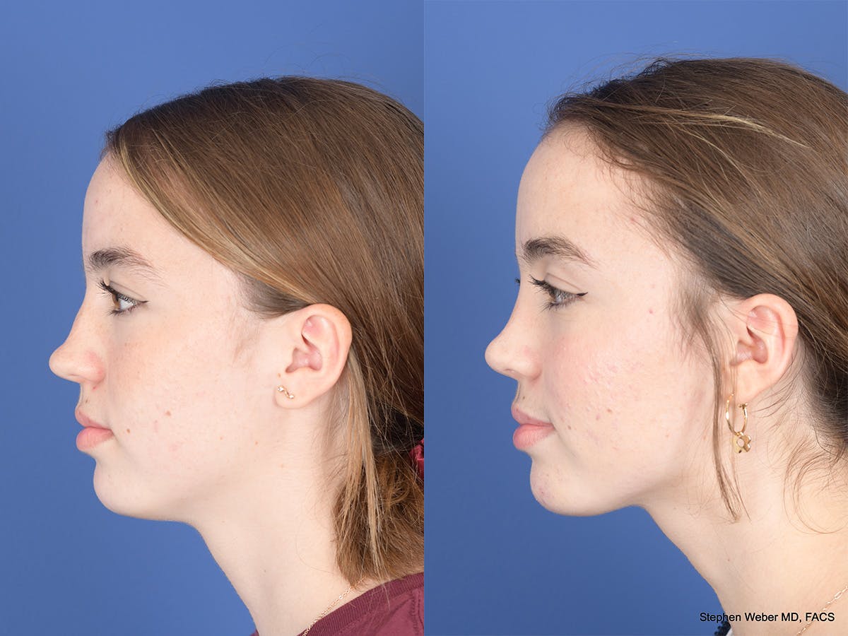 Rhinoplasty Before & After Gallery - Patient 190545 - Image 2