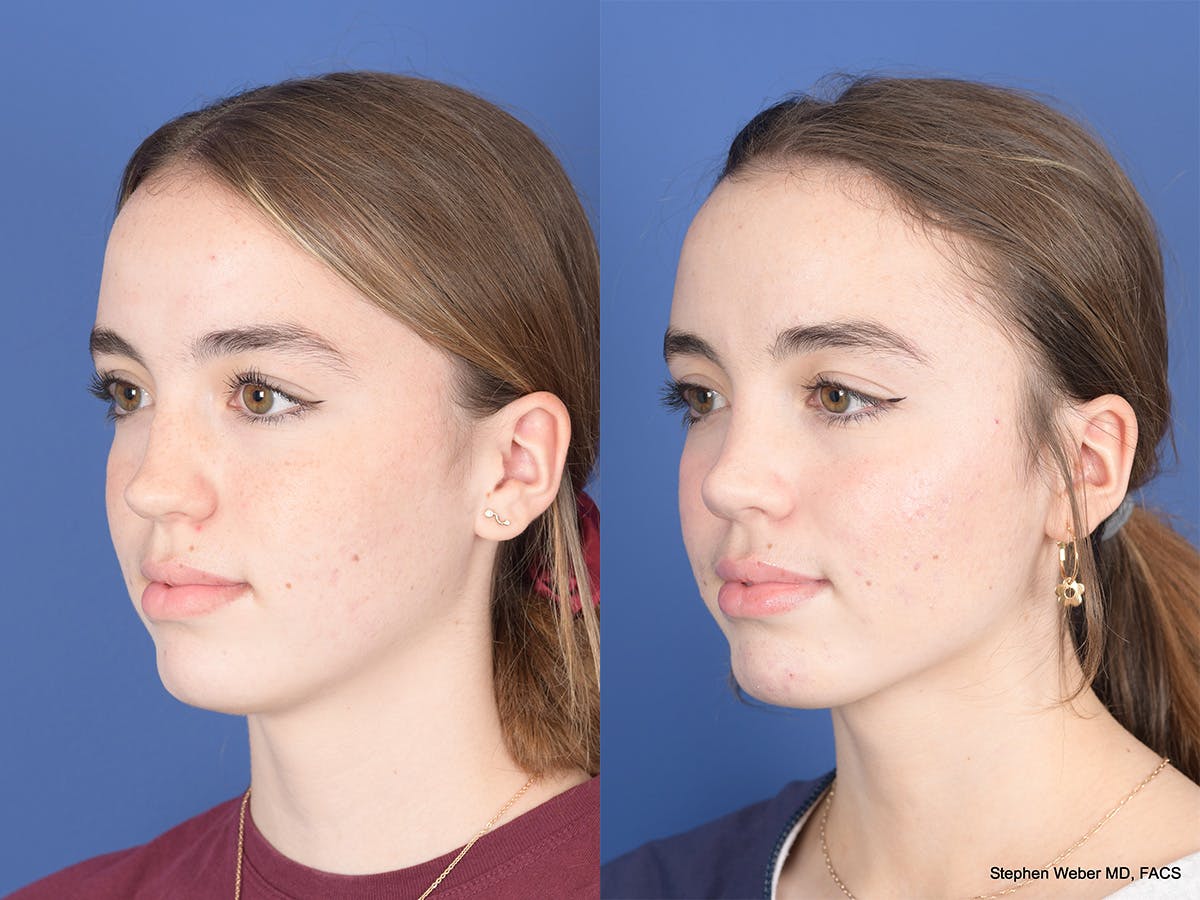 Rhinoplasty Before & After Gallery - Patient 190545 - Image 3