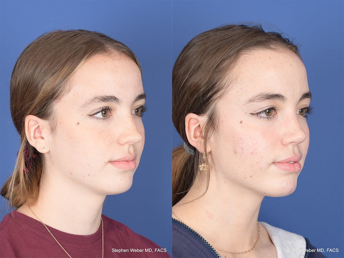 Rhinoplasty Before & After Gallery - Patient 190545 - Image 4