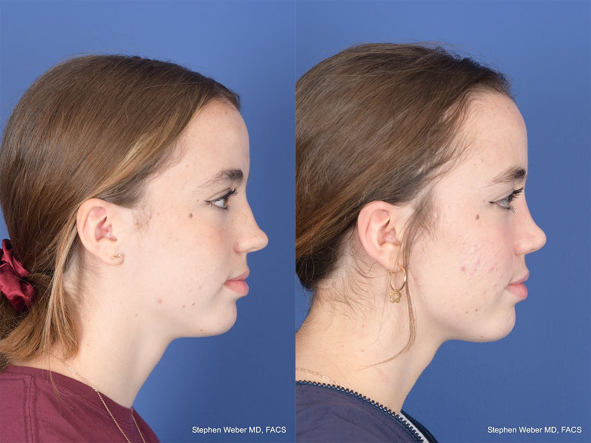 Rhinoplasty Before & After Gallery - Patient 190545 - Image 5