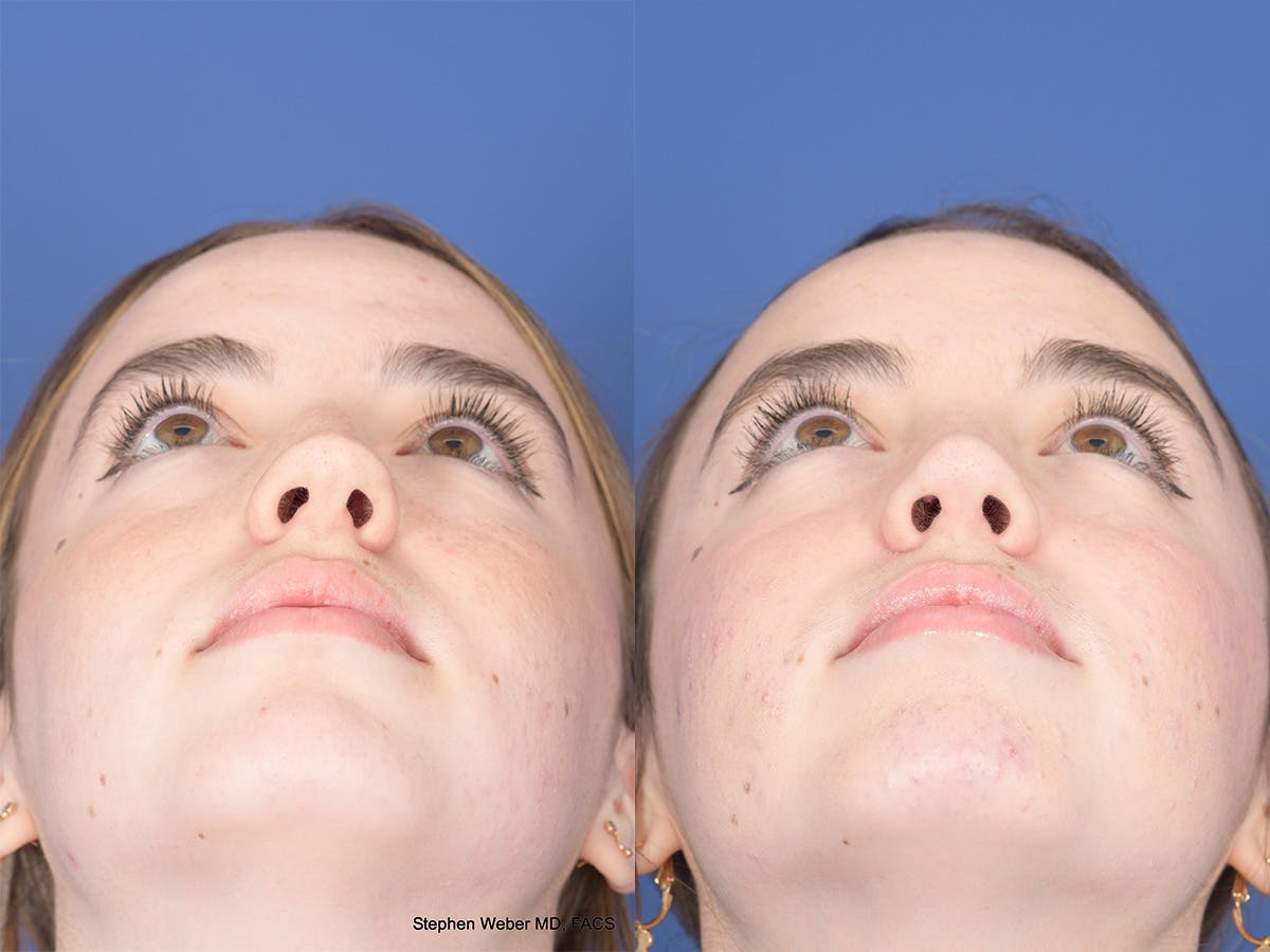 Rhinoplasty Before & After Gallery - Patient 190545 - Image 6