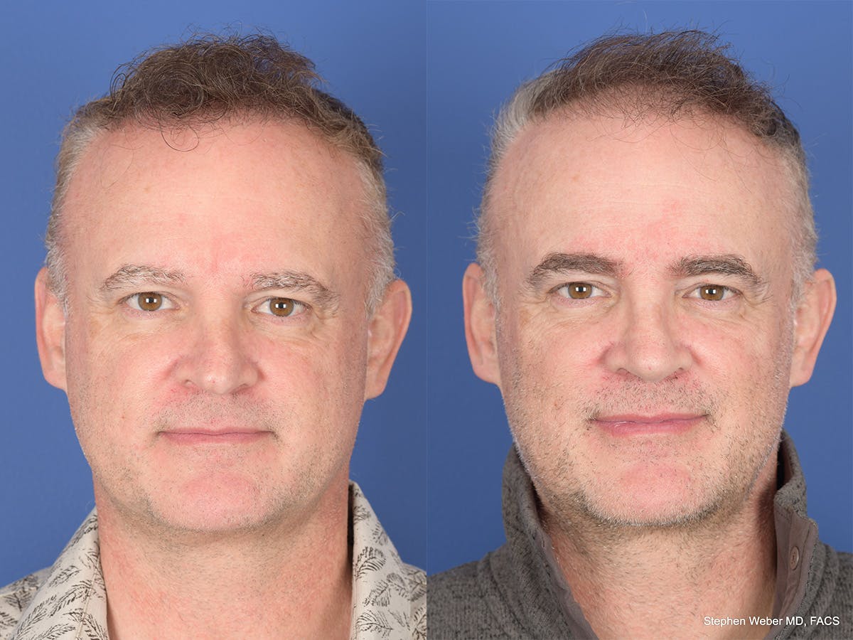 Rhinoplasty Before & After Gallery - Patient 334875 - Image 1