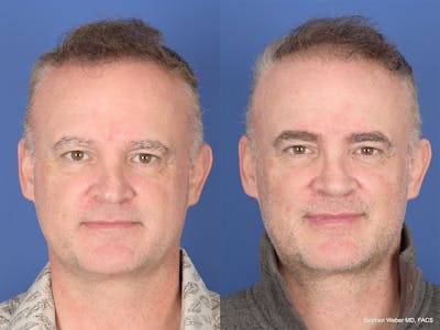 Rhinoplasty Before & After Gallery - Patient 334875 - Image 1