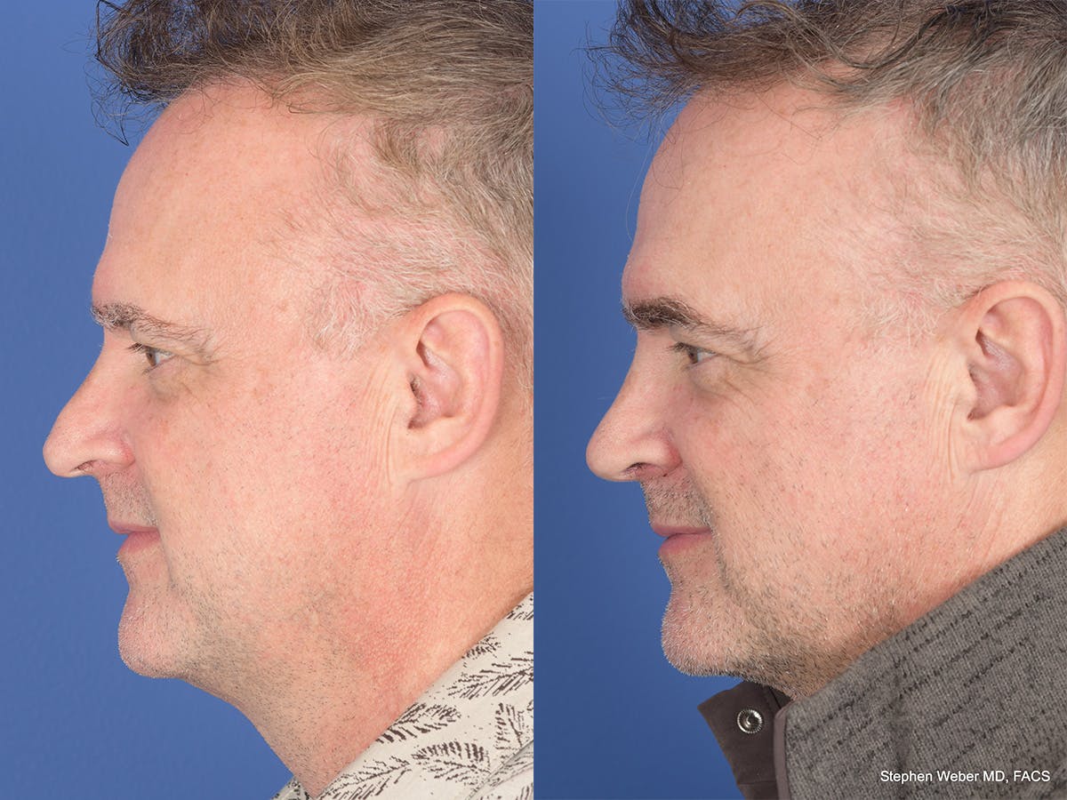 Rhinoplasty Before & After Gallery - Patient 334875 - Image 2