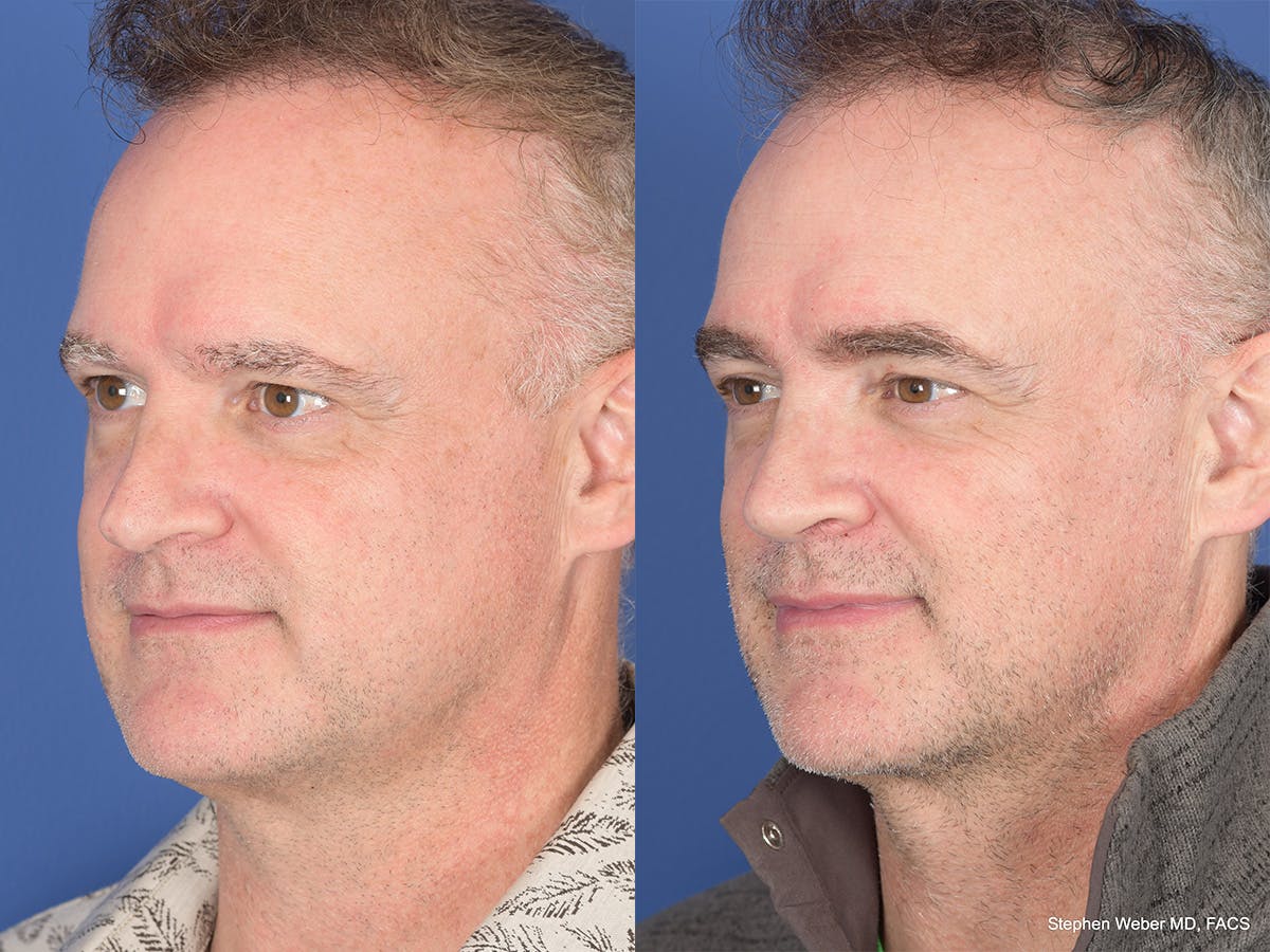 Rhinoplasty Before & After Gallery - Patient 334875 - Image 3