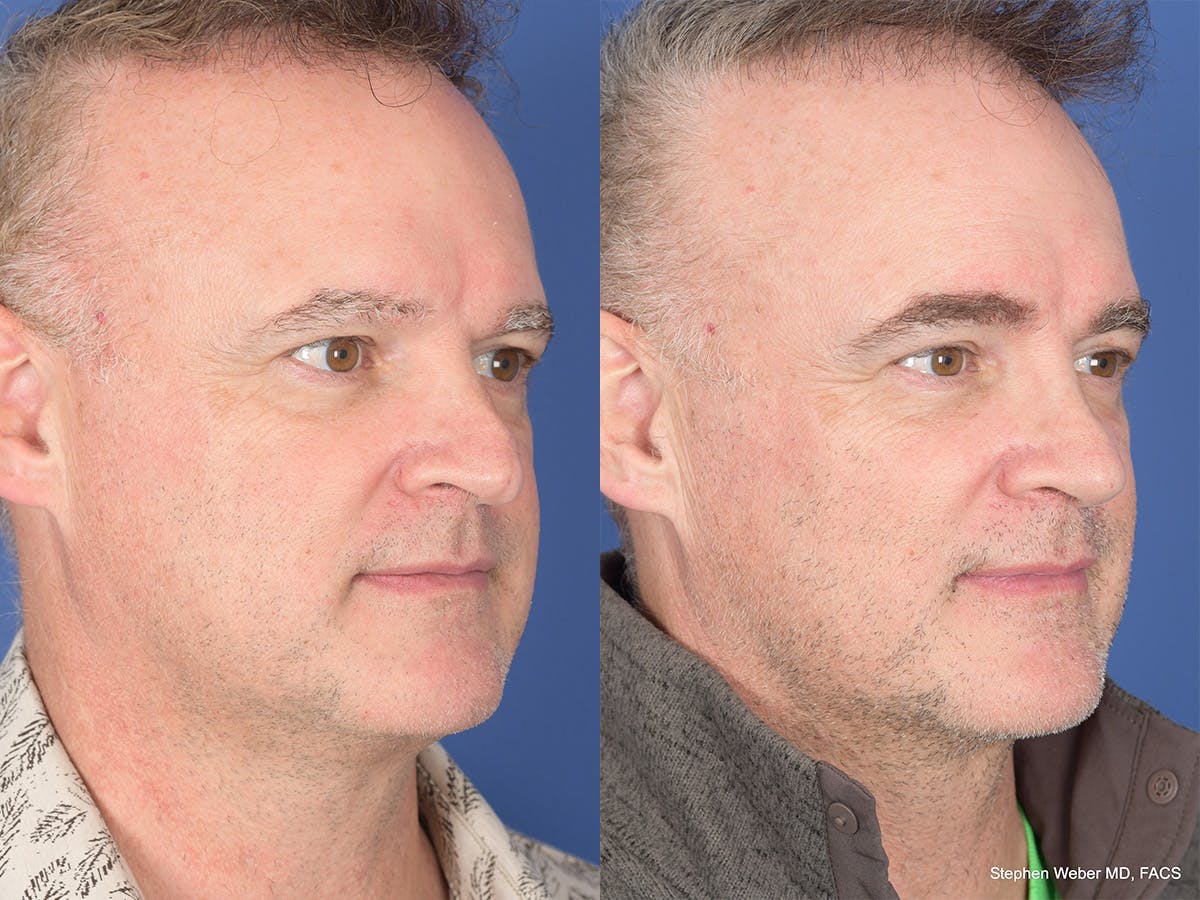 Rhinoplasty Before & After Gallery - Patient 334875 - Image 4