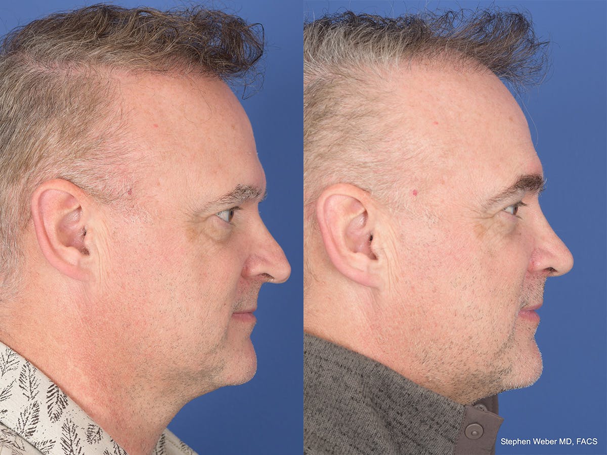 Rhinoplasty Before & After Gallery - Patient 334875 - Image 5