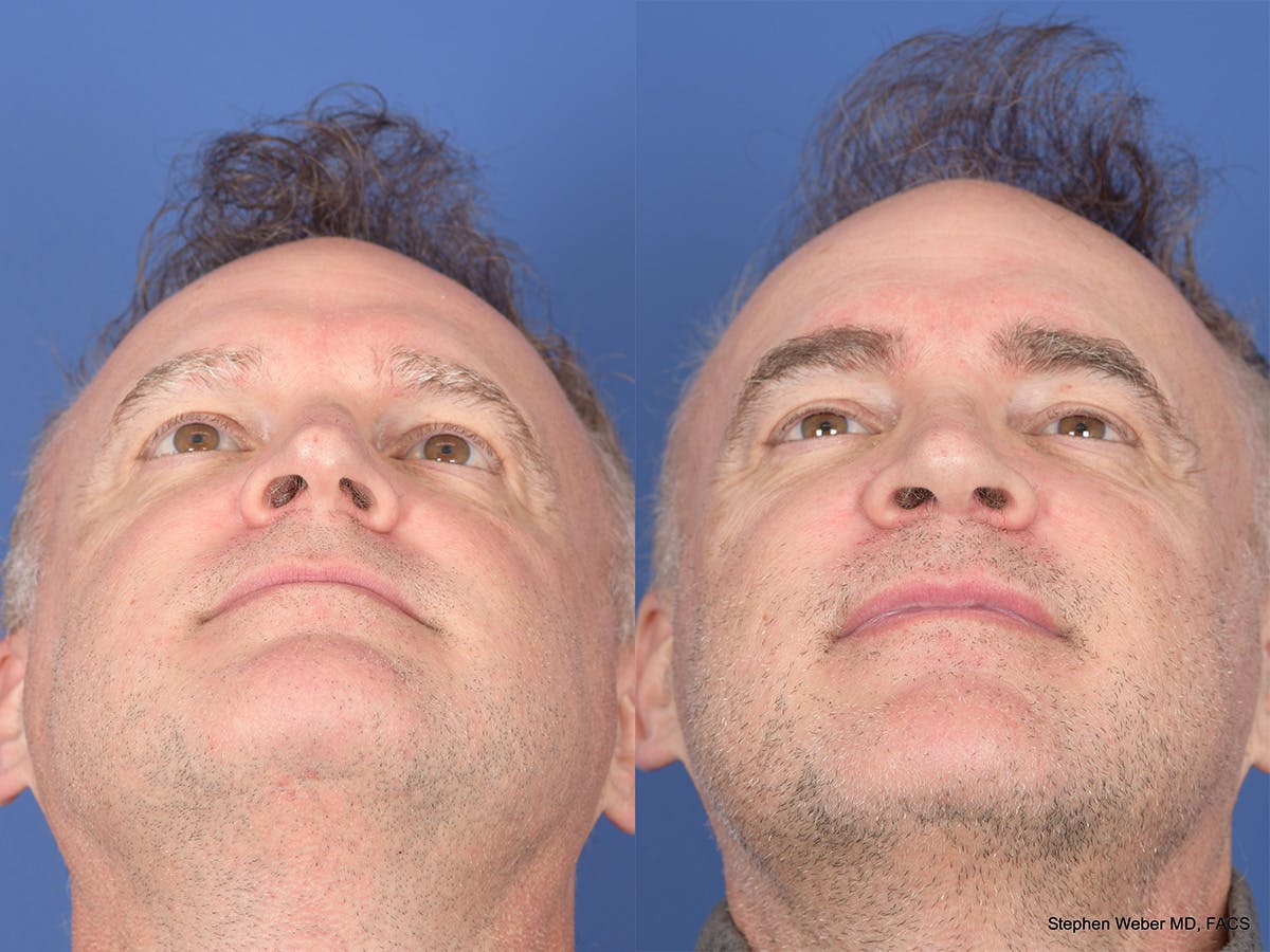 Rhinoplasty Before & After Gallery - Patient 334875 - Image 6