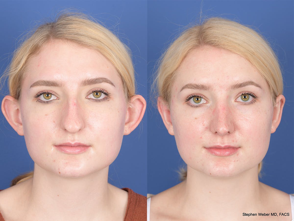 Rhinoplasty Before & After Gallery - Patient 424160 - Image 1