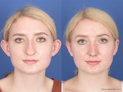 Rhinoplasty Before & After Gallery - Patient 424160 - Image 1