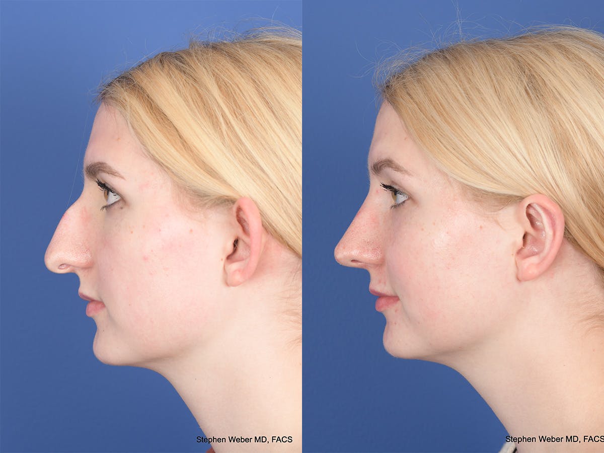 Rhinoplasty Before & After Gallery - Patient 424160 - Image 2