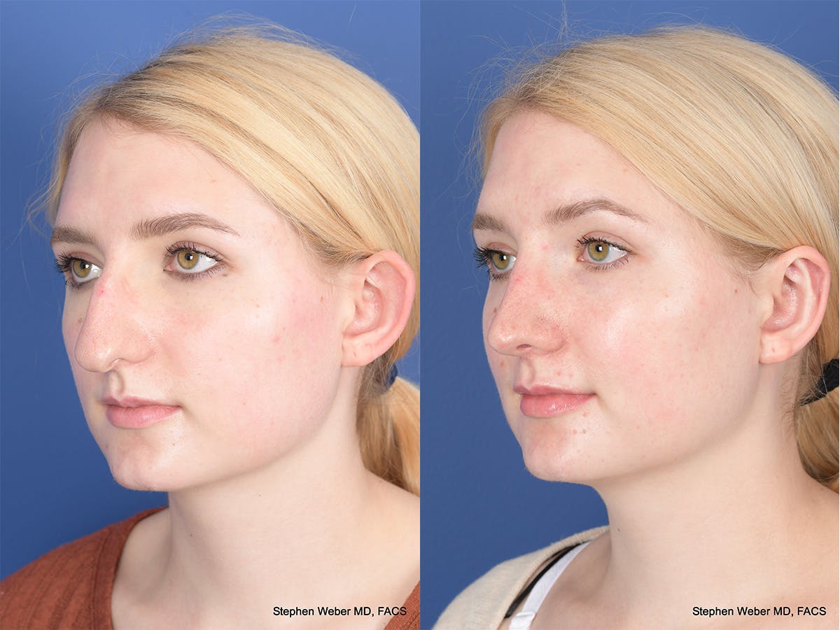 Rhinoplasty Before & After Gallery - Patient 424160 - Image 3