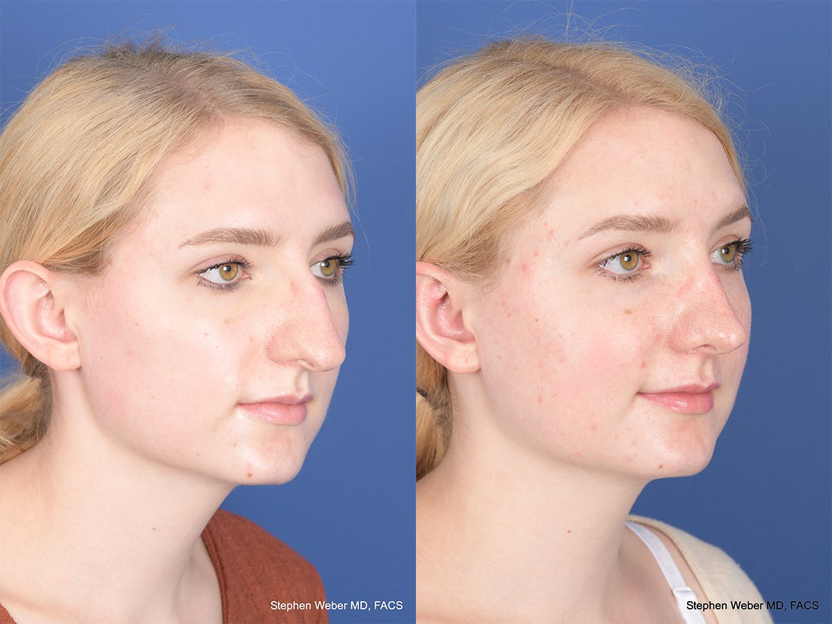 Rhinoplasty Before & After Gallery - Patient 424160 - Image 4