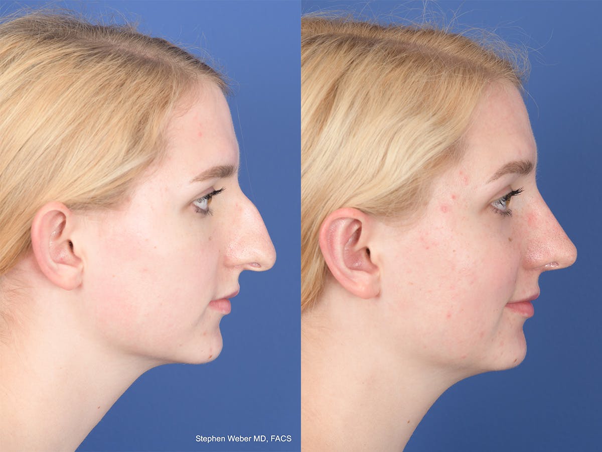 Rhinoplasty Before & After Gallery - Patient 424160 - Image 5