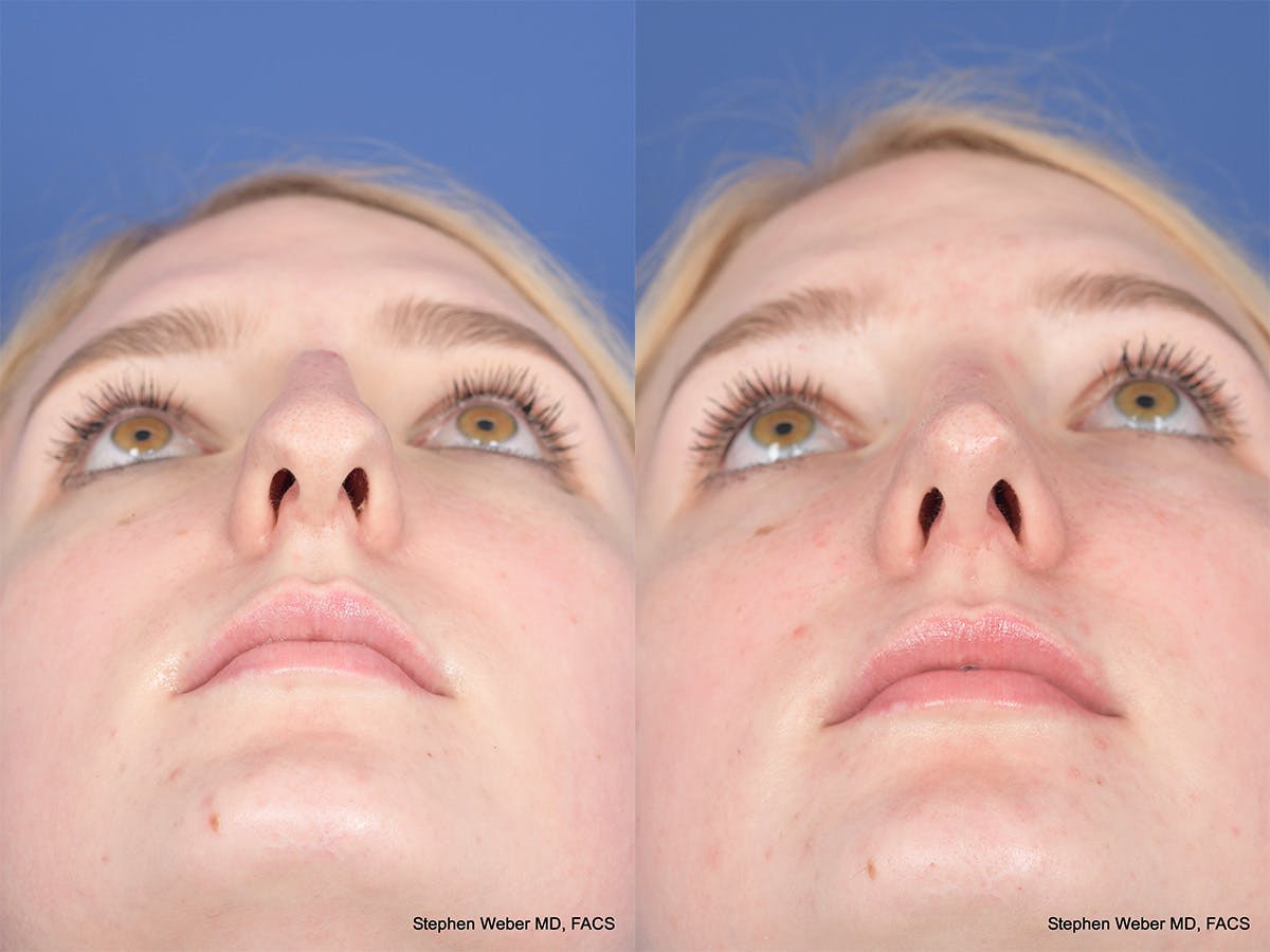 Rhinoplasty Before & After Gallery - Patient 424160 - Image 6